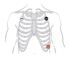 One Channel ECG/EKG, Recorded from the Chest