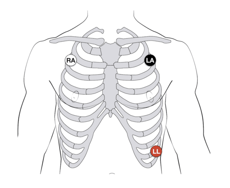 File:ECGleadplacement cropped.png