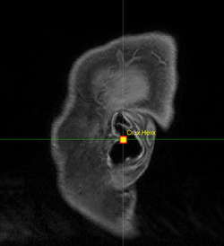 Sagittal MR image of an ear, with crux helix marked with yellow crosshairs
