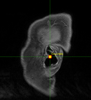Sagittal MR image of an ear, with crux helix marked with yellow crosshairs